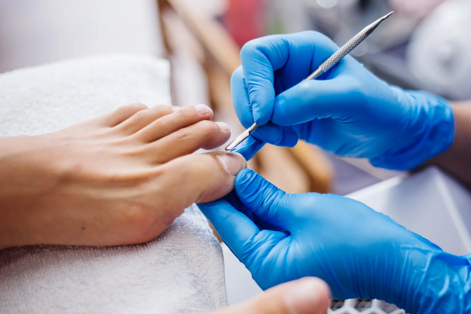 Tratamiento de onicocriptosis (uña encarnada) en Tijuana, B.C. | Centro Médico Noriega Durán